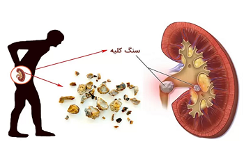 علائم سنگ کلیه در کودکان
